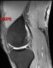 Figure 4 for case Semitendinosus tendon tear, retracted( RID2717 )